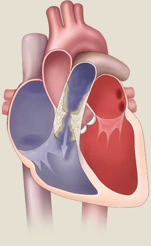 Pulmonary Stenosis