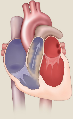 Pulmonary Regurgitation